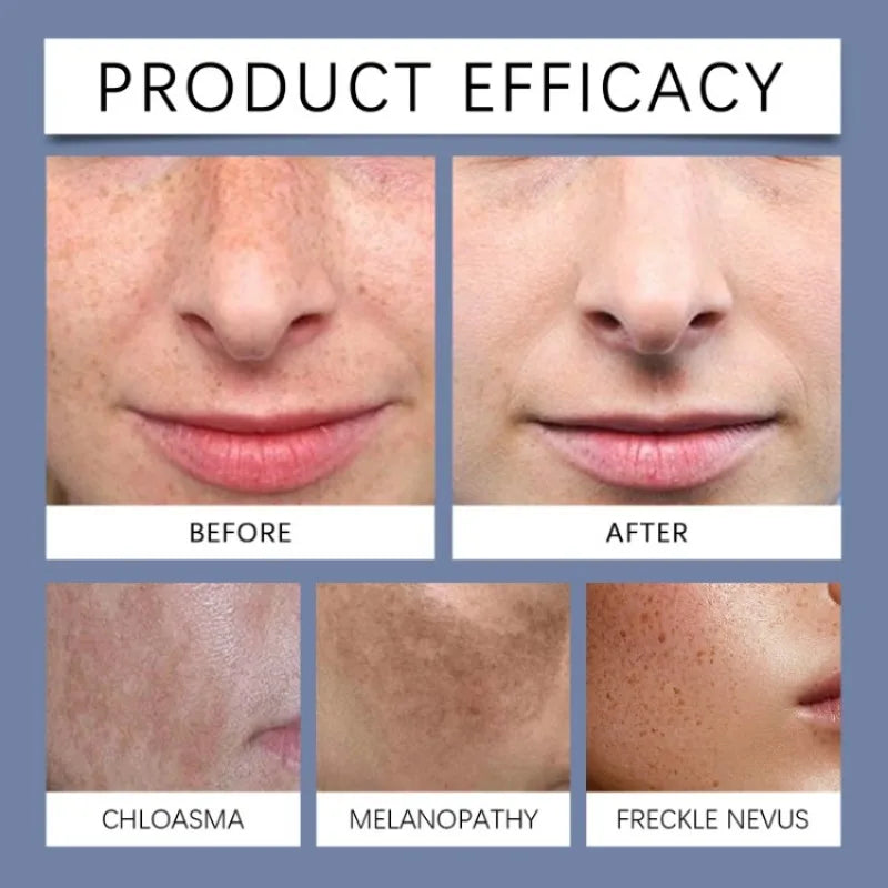 OUHOE Freckle Diminishing